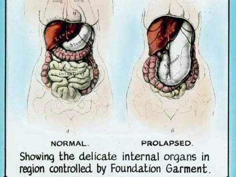Anatomical diagrams comparing the 'delicate internal organs' of a woman who wears a foundation garment and one who doesn't. The one who doesn't has organs which have been labelled as 'prolapsed'.